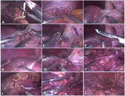 The safety and feasibility of laparoscopic anatomical left hemihepatectomy along the middle hepatic vein from the head side approach